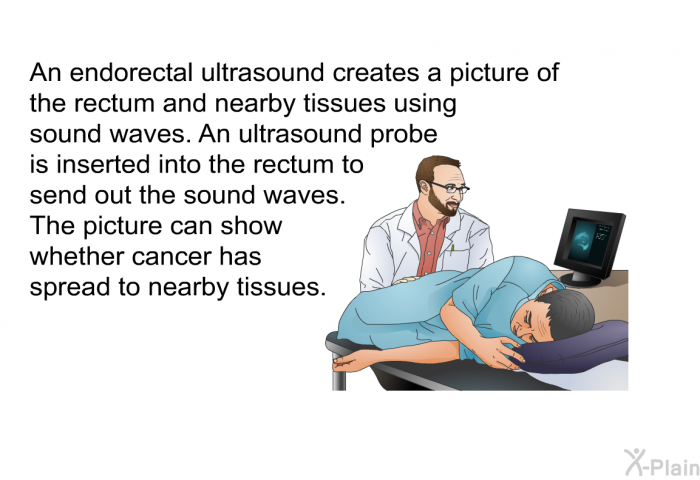 An endorectal ultrasound creates a picture of the rectum and nearby tissues using sound waves. An ultrasound probe is inserted into the rectum to send out the sound waves. The picture can show whether cancer has spread to nearby tissues.