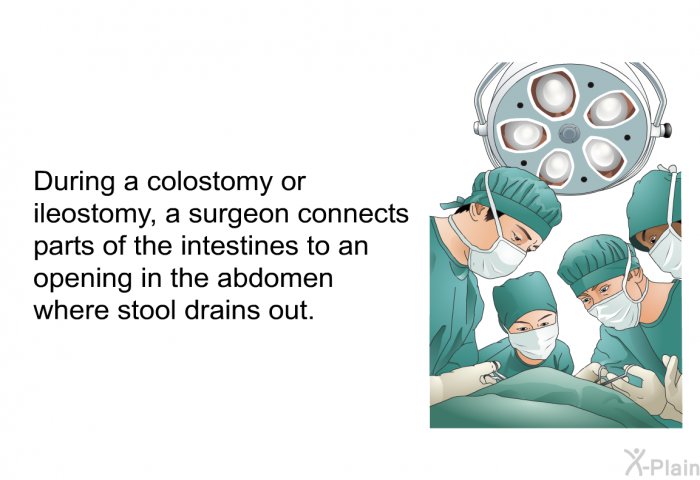 During a colostomy or ileostomy, a surgeon connects parts of the intestines to an opening in the abdomen where stool drains out.