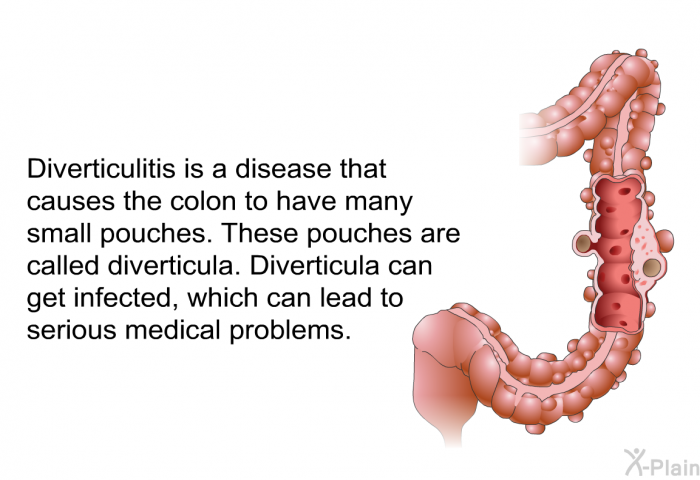 Diverticulitis is a disease that causes the colon to have many small pouches. These pouches are called diverticula. Diverticula can get infected, which can lead to serious medical problems.