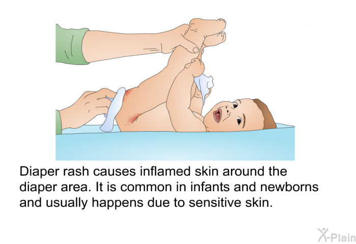 Diaper rash causes inflamed skin around the diaper area. It is common in infants and newborns and usually happens due to sensitive skin.