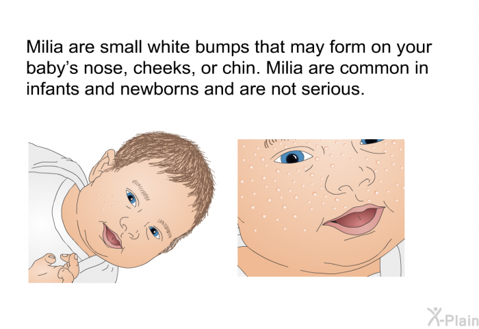 Milia are small white bumps that may form on your baby's nose, cheeks, or chin. Milia are common in infants and newborns and are not serious.