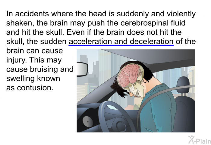 In accidents where the head is suddenly and violently shaken, the brain may push the cerebrospinal fluid and hit the skull. Even if the brain does not hit the skull, the sudden acceleration and deceleration of the brain can cause injury. This may cause bruising and swelling known as contusion.
