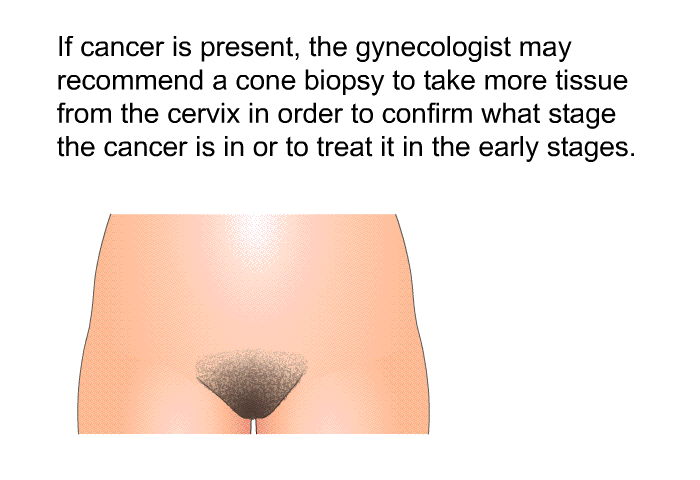 If cancer is present, the gynecologist may recommend a cone biopsy to take more tissue from the cervix in order to confirm what stage the cancer is in or to treat it in the early stages.