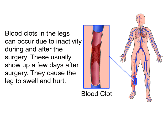Blood clots in the legs can occur due to inactivity during and after the surgery. These usually show up a few days after surgery. They cause the leg to swell and hurt.