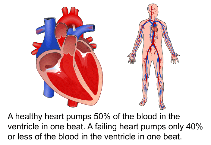 A healthy heart pumps 50% of the blood in the ventricle in one beat. A failing heart pumps only 40% or less of the blood in the ventricle in one beat.