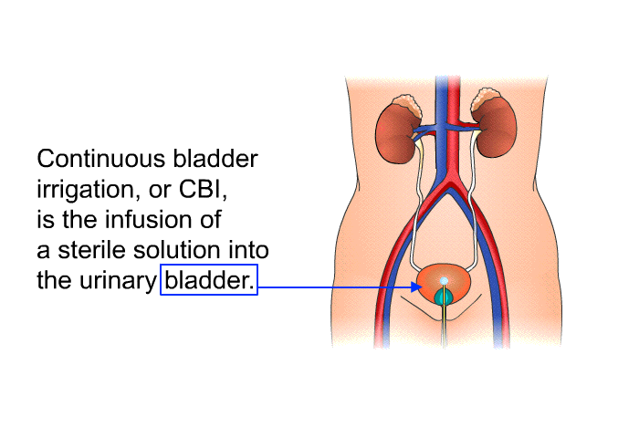 Continuous bladder irrigation, or CBI, is the infusion of a sterile solution into the urinary bladder.