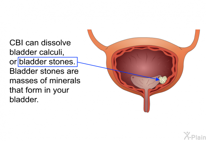 CBI can dissolve bladder calculi, or bladder stones. Bladder stones are masses of minerals that form in your bladder.