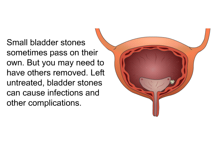 Small bladder stones sometimes pass on their own. But you may need to have others removed. Left untreated, bladder stones can cause infections and other complications.