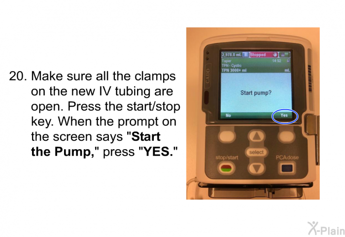 <OL START=20> Make sure all the clamps on the new IV tubing are open. Press the start/stop key. When the prompt on the screen says &ldquo;<B>Start the Pump</B>,&rdquo; press &ldquo;<B>YES</B>.&rdquo;
