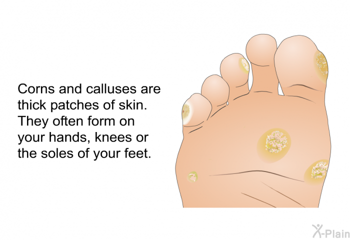 Corns and calluses are thick, patches of skin. They often form on your hands, knees or the soles of your feet.