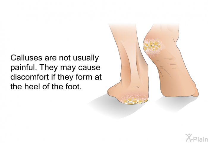 Calluses are not usually painful. They may cause discomfort if they form at the heel of the foot.