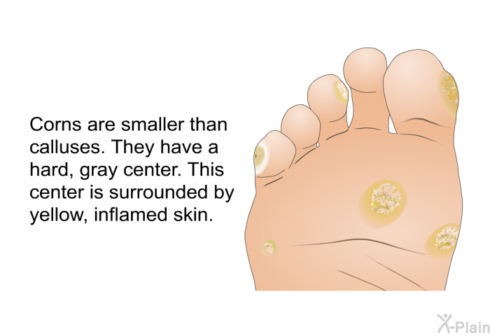 Corns are smaller than calluses. They have a hard, gray center. This center is surrounded by yellow, inflamed skin.
