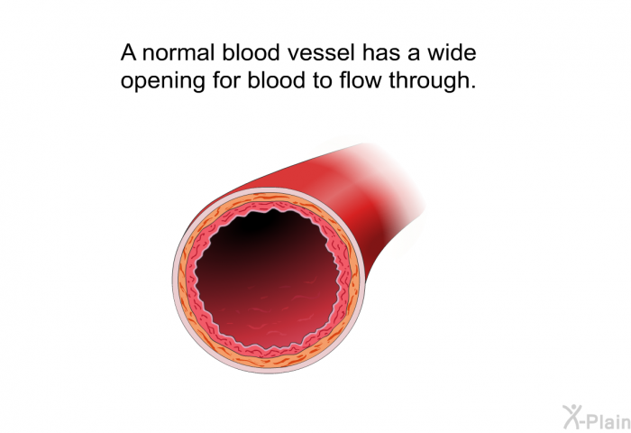 A normal blood vessel has a wide opening for blood to flow through.