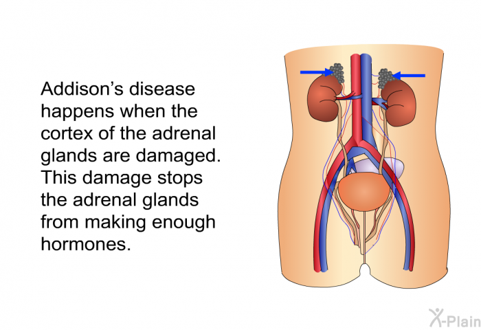 Addison's disease happens when the cortex of the adrenal glands are damaged. This damage stops the adrenal glands from making enough hormones.