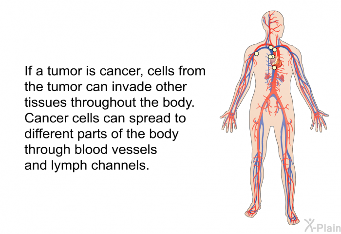If a tumor is cancer, cells from the tumor can invade other tissues throughout the body. Cancer cells can spread to different parts of the body through blood vessels and lymph channels.