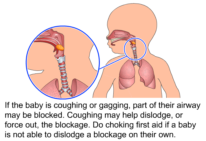 If the baby is coughing or gagging, part of their airway may be blocked. Coughing may help dislodge, or force out, the blockage. Do choking first aid if a baby is not able to dislodge a blockage on their own.