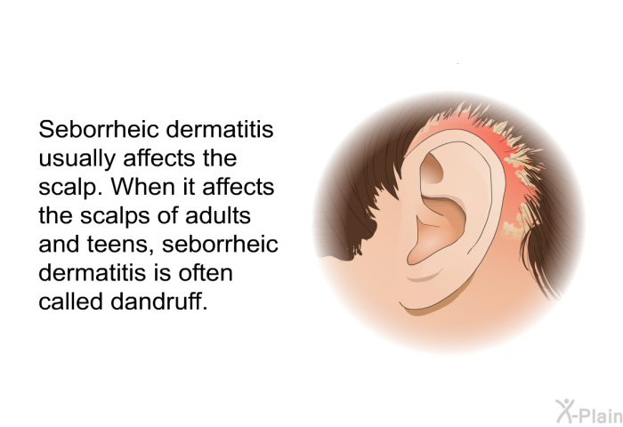 Seborrheic dermatitis usually affects the scalp. When it affects the scalps of adults and teens, seborrheic dermatitis is often called dandruff.