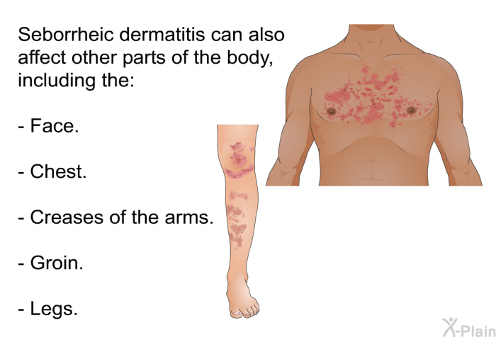 Seborrheic dermatitis can also affect other parts of the body, including the:  Face. Chest. Creases of the arms. Groin. Legs.
