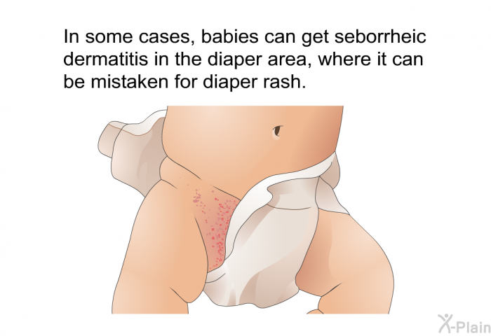 In some cases, babies can get seborrheic dermatitis in the diaper area, where it can be mistaken for diaper rash.