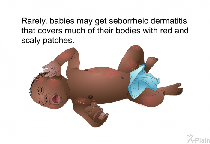 Rarely, babies may get seborrheic dermatitis that covers much of their bodies with red and scaly patches.