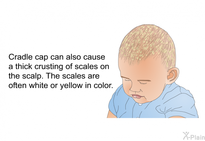 Cradle cap can also cause a thick crusting of scales on the scalp. The scales are often white or yellow in color.