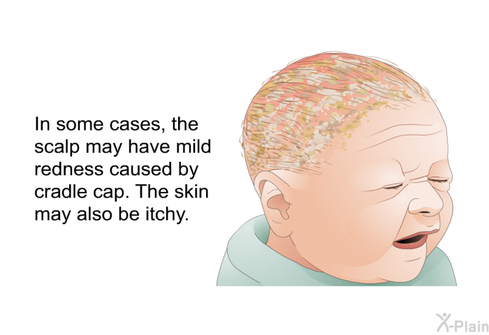 In some cases, the scalp may have mild redness caused by cradle cap. The skin may also be itchy.