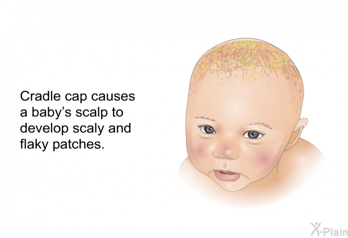 Cradle cap causes a baby's scalp to develop scaly and flaky patches.