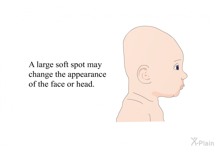 A large soft spot may change the appearance of the face or head.