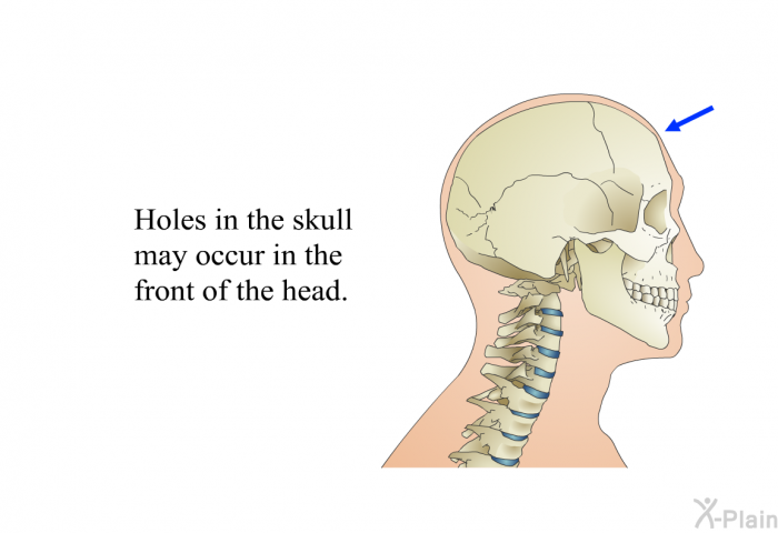 Holes in the skull may occur in the front of the head.