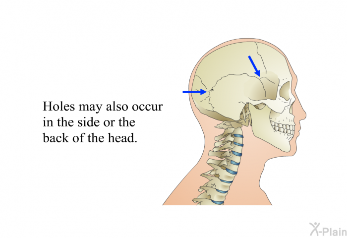 Holes may also occur in the side or the back of the head.