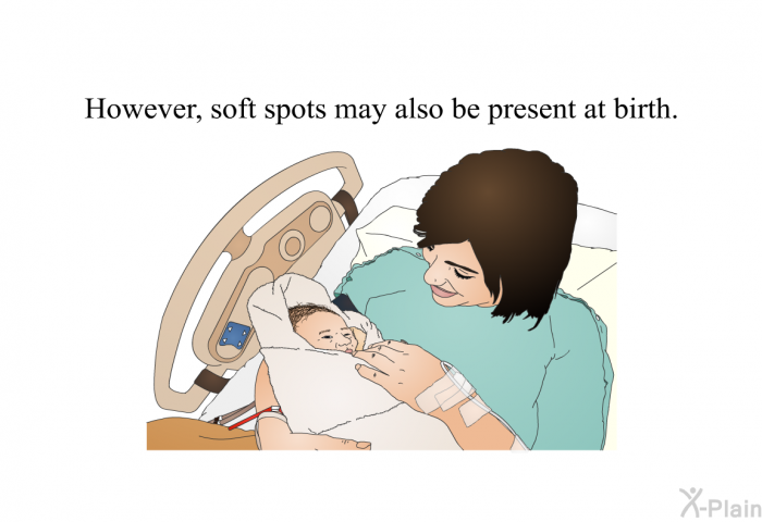 However, soft spots may also be present at birth.