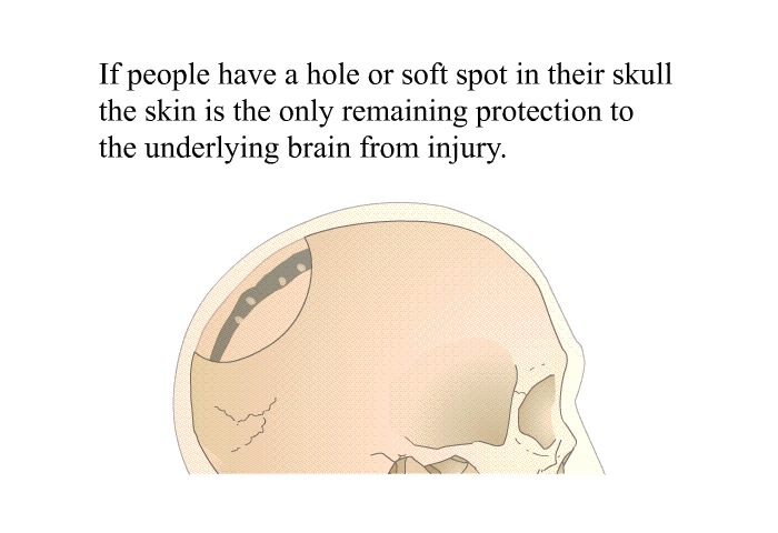 If people have a hole or soft spot in their skull the skin is the only remaining protection to the underlying brain from injury.