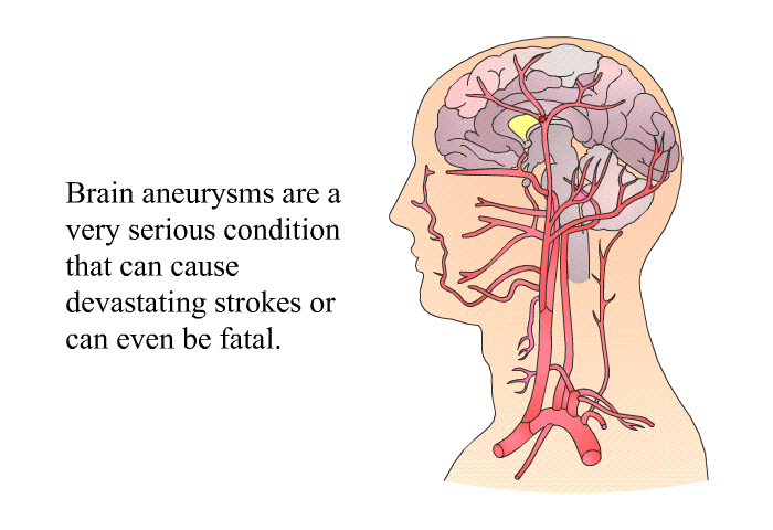 Brain aneurysms are a very serious condition that can cause devastating strokes or can even be fatal.