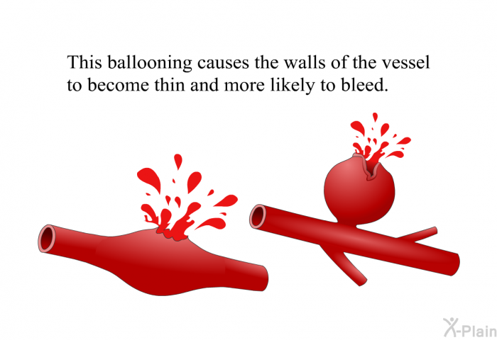 This ballooning causes the walls of the vessel to become thin and more likely to bleed.