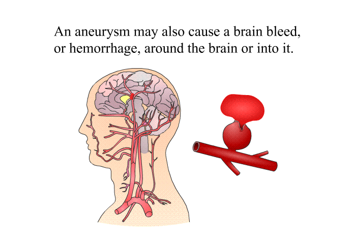 An aneurysm may also cause a brain bleed, or hemorrhage, around the brain or into it.