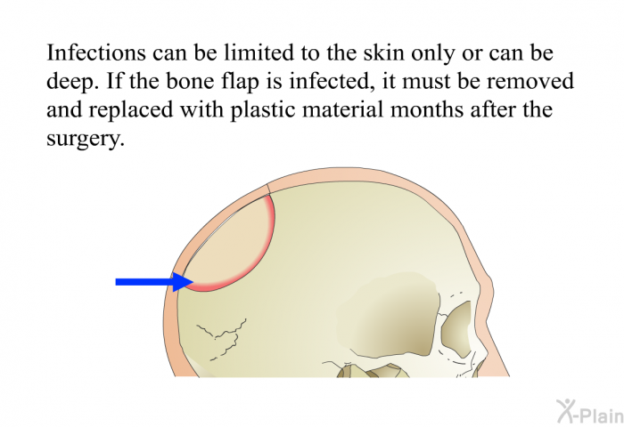 Infections can be limited to the skin only or can be deep. If the bone flap is infected, it must be removed and replaced with plastic material months after the surgery.