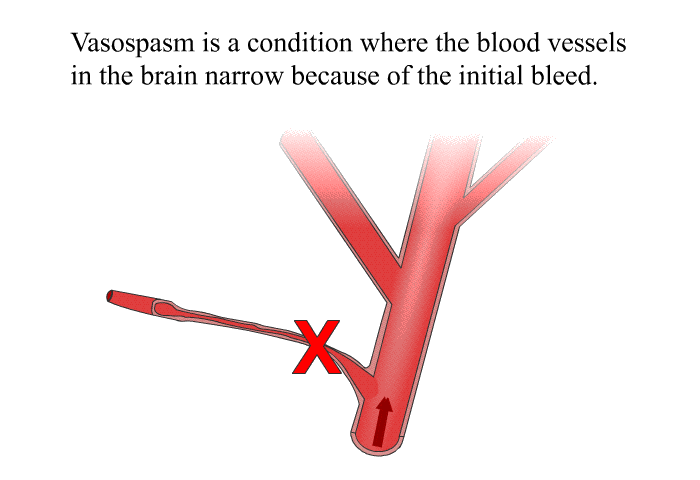 Vasospasm is a condition where the blood vessels in the brain narrow because of the initial bleed.