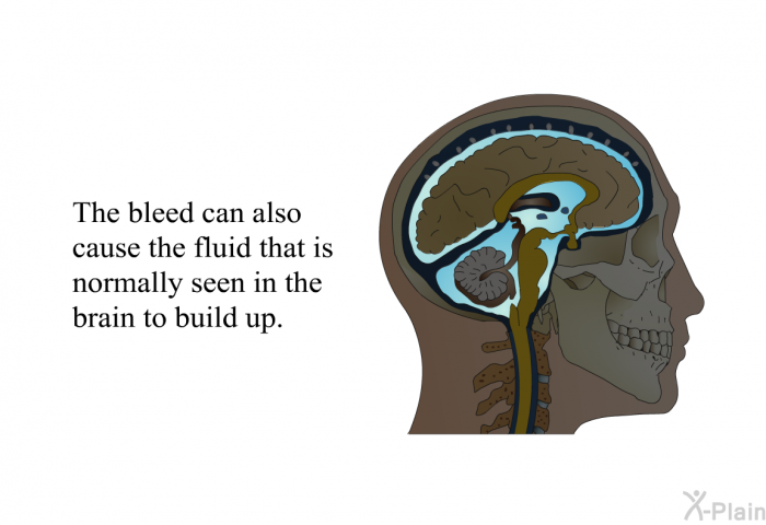 The bleed can also cause the fluid that is normally seen in the brain to build up.