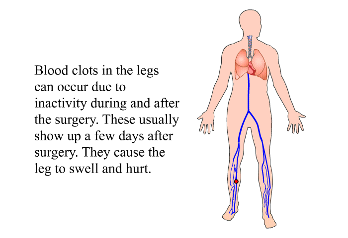 Blood clots in the legs can occur due to inactivity during and after the surgery. These usually show up a few days after surgery. They cause the leg to swell and hurt.