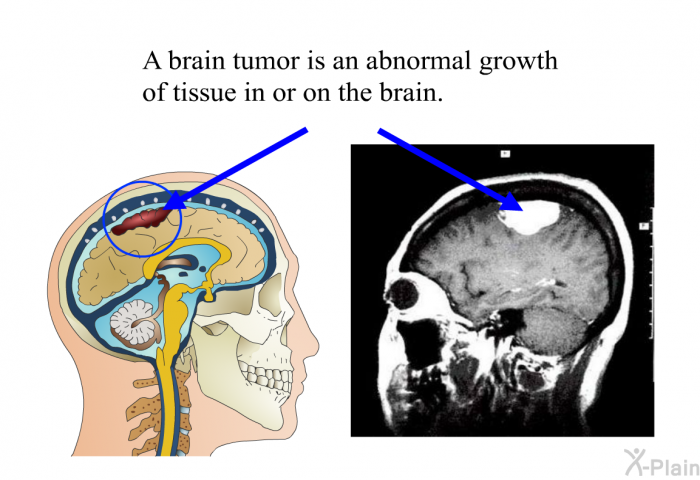 A brain tumor is an abnormal growth of tissue in or on the brain.
