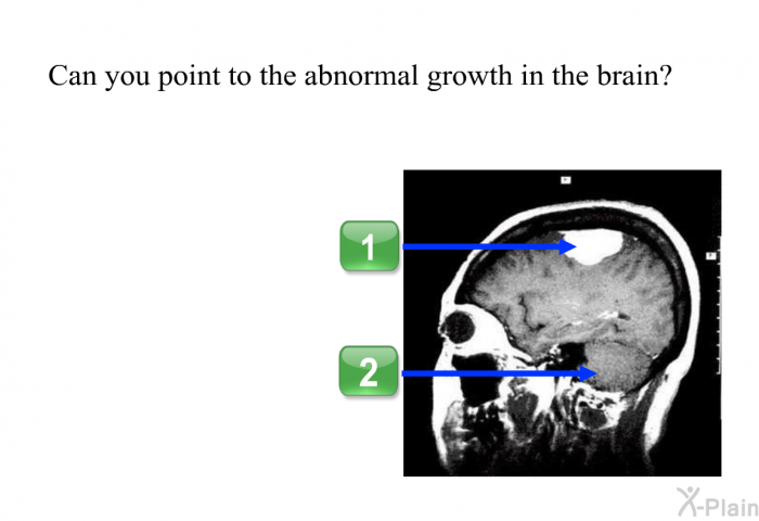 Can you point to the abnormal growth in the brain?