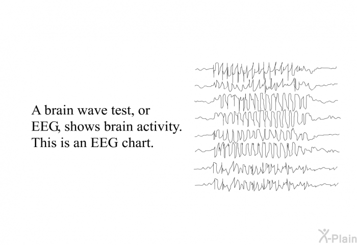 A brain wave test, or EEG, shows brain activity. This is an EEG chart.