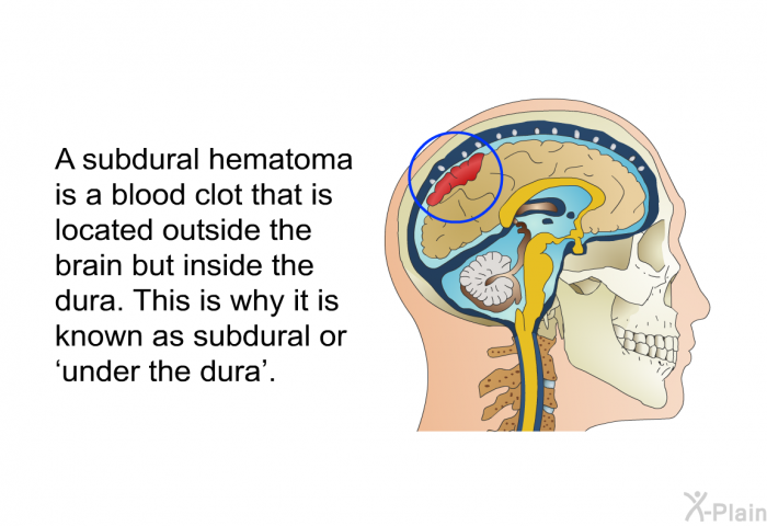 A subdural hematoma is a blood clot that is located outside the brain but inside the dura. This is why it is known as subdural or  under the dura'.