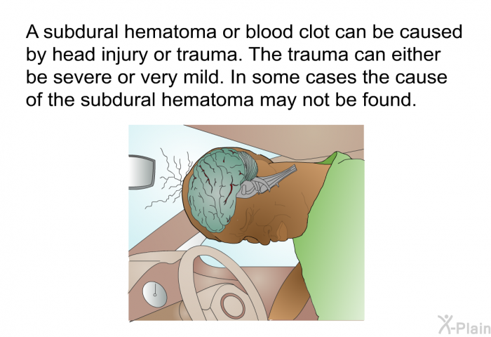 A subdural hematoma or blood clot can be caused by head injury or trauma. The trauma can either be severe or very mild. In some cases the cause of the subdural hematoma may not be found.