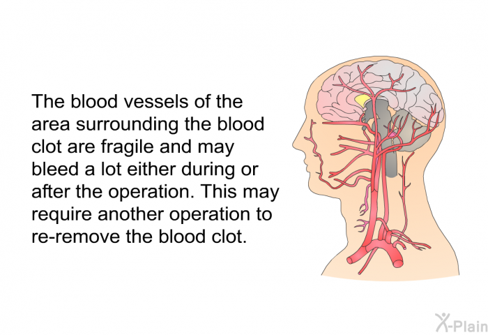 The blood vessels of the area surrounding the blood clot are fragile and may bleed a lot either during or after the operation. This may require another operation to re-remove the blood clot.