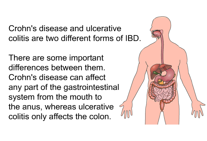 Crohn's disease and ulcerative colitis are two different forms of IBD. There are some important differences between them. Crohn's disease can affect any part of the gastrointestinal system from the mouth to the anus, whereas ulcerative colitis only affects the colon.