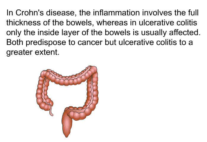 In Crohn's disease, the inflammation involves the full thickness of the bowels, whereas in ulcerative colitis only the inside layer of the bowels is usually affected. Both predispose to cancer but ulcerative colitis to a greater extent.