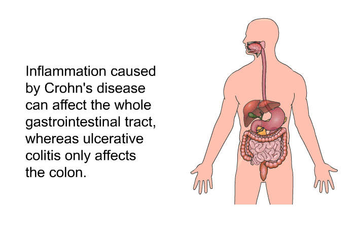 Inflammation caused by Crohn's disease can affect the whole gastrointestinal tract, whereas ulcerative colitis only affects the colon.