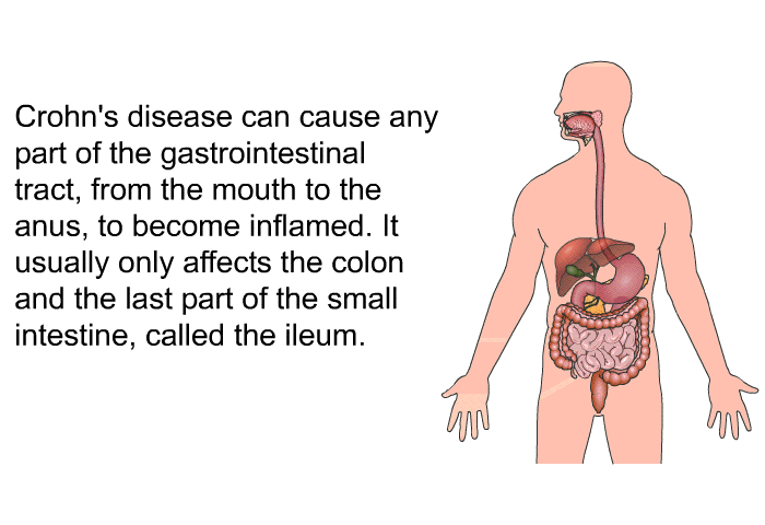 Crohn's disease can cause any part of the gastrointestinal tract, from the mouth to the anus, to become inflamed. It usually only affects the colon and the last part of the small intestine, called the ileum.
