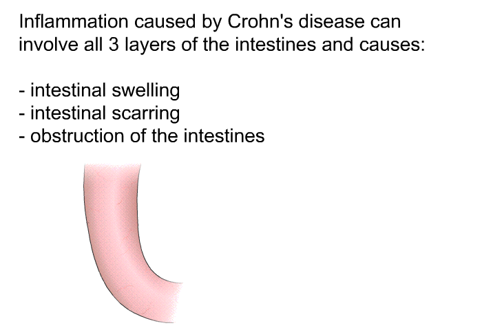 Inflammation caused by Crohn's disease can involve all 3 layers of the intestines and causes:  intestinal swelling intestinal scarring obstruction of the intestines